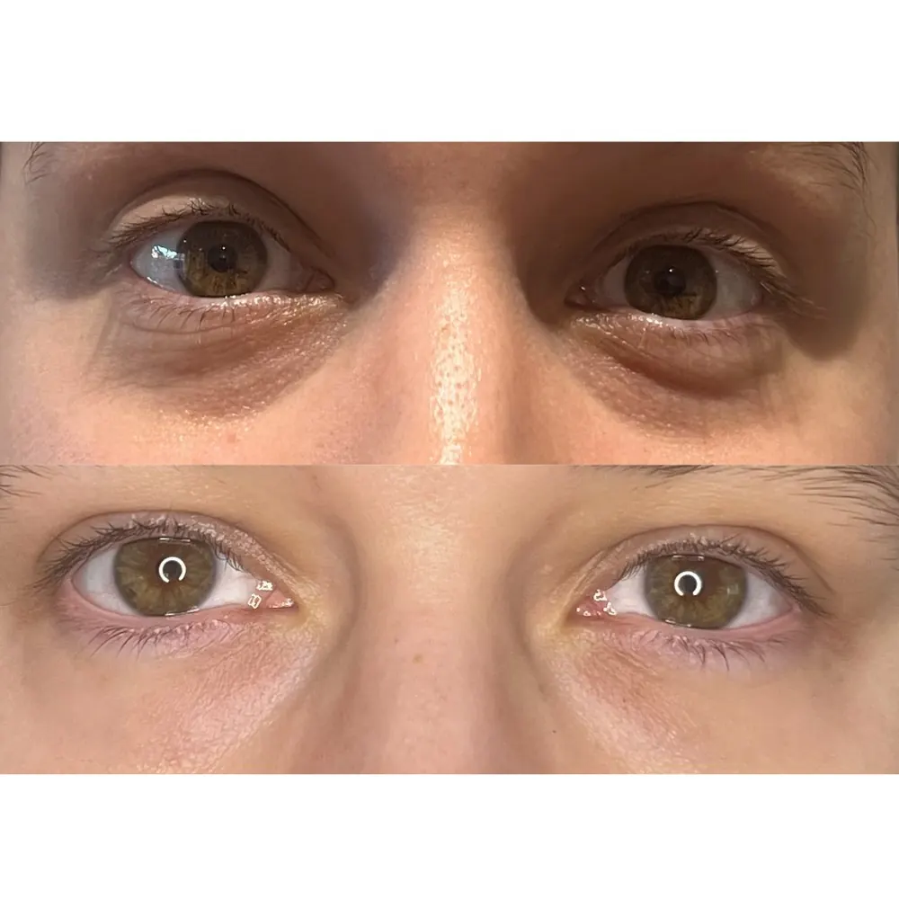 Before and after under-eye treatment result showing the eye area